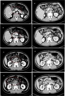 Systemic Therapy for Microsatellite Instability Small Bowel Adenocarcinoma With Mesenteric Vascular Embolism as Initial Symptom: A Case Report